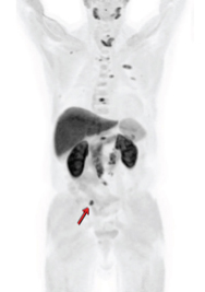 Fluciclovine (Axumin) PET Scan