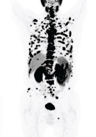 PSMA PET Scan PSMA PET Scan