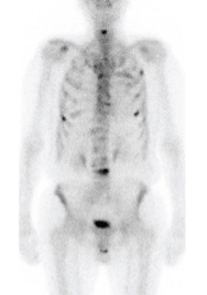 FDG PET Scan